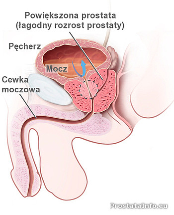 Łagodny przerost prostaty